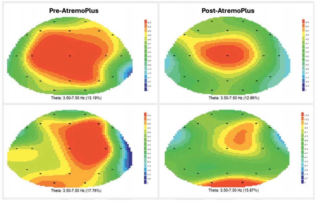 ATremoPlus ondes cerebrales - AtremoPlus natural L-Dopa: less chronic fatigue and daytime sleepiness!